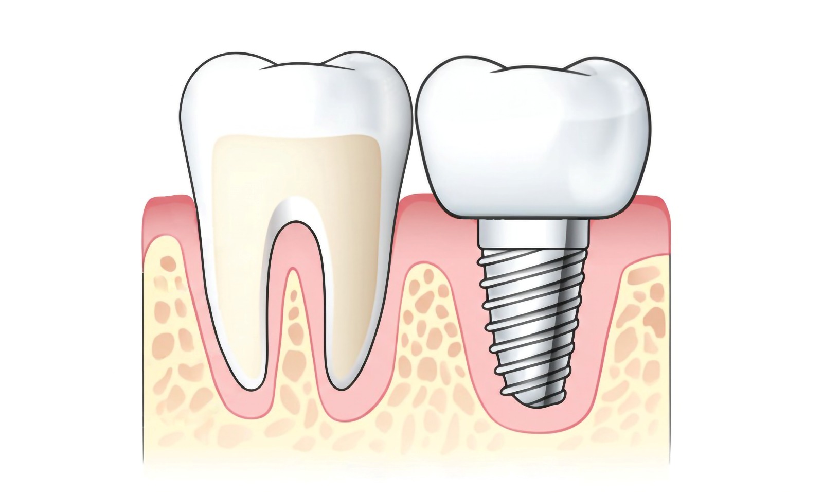 Implantologie avansată